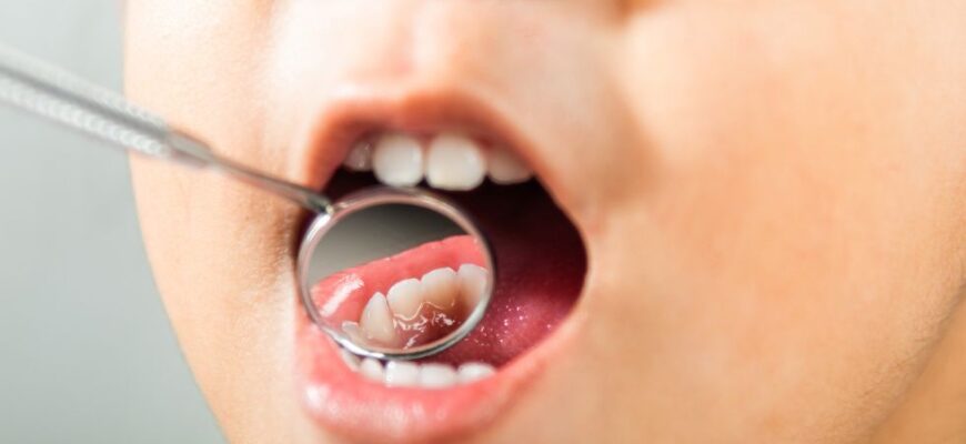 mitos salud dental